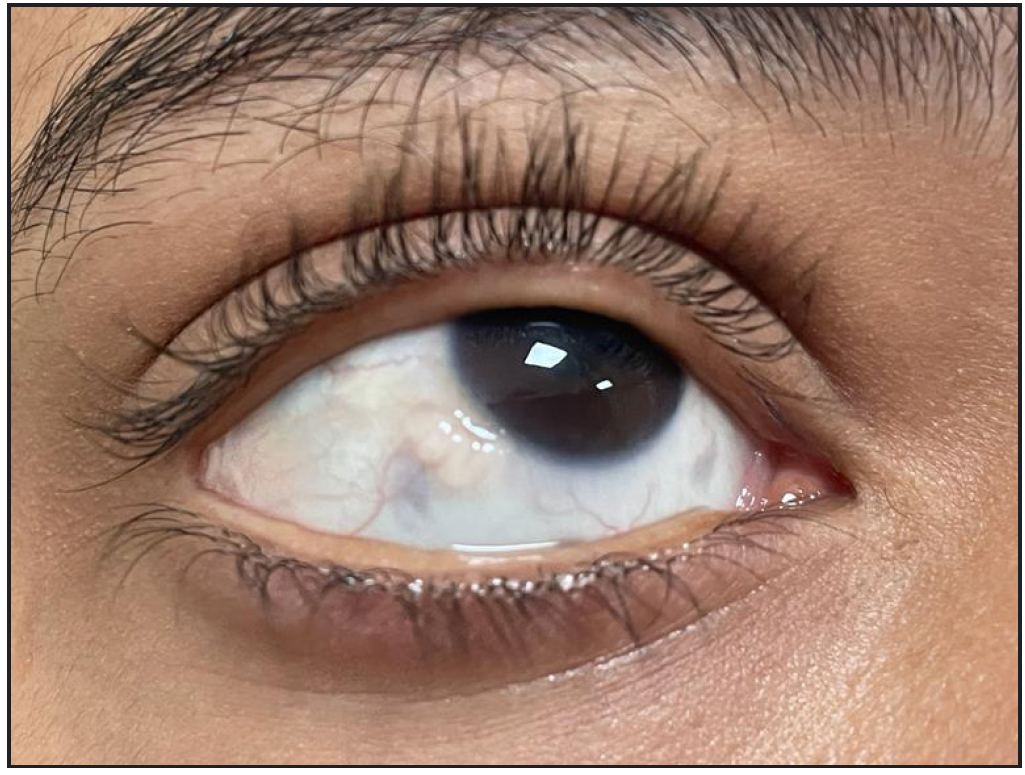 Yellowish nodule on the sclera (conjunctival neuroma) along with thick eyebrows and eyelashes.
