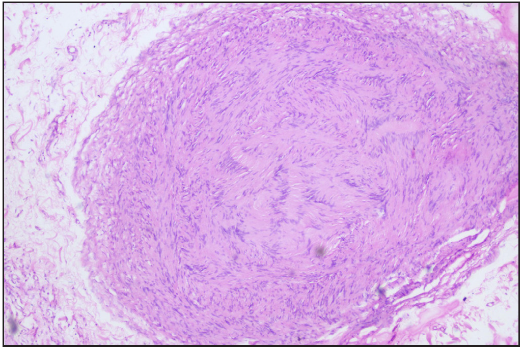 Proliferation of spindle-shaped Schwann cells arranged in a tortuous, unorganised manner. (Haematoxylin and eosin, 400x).