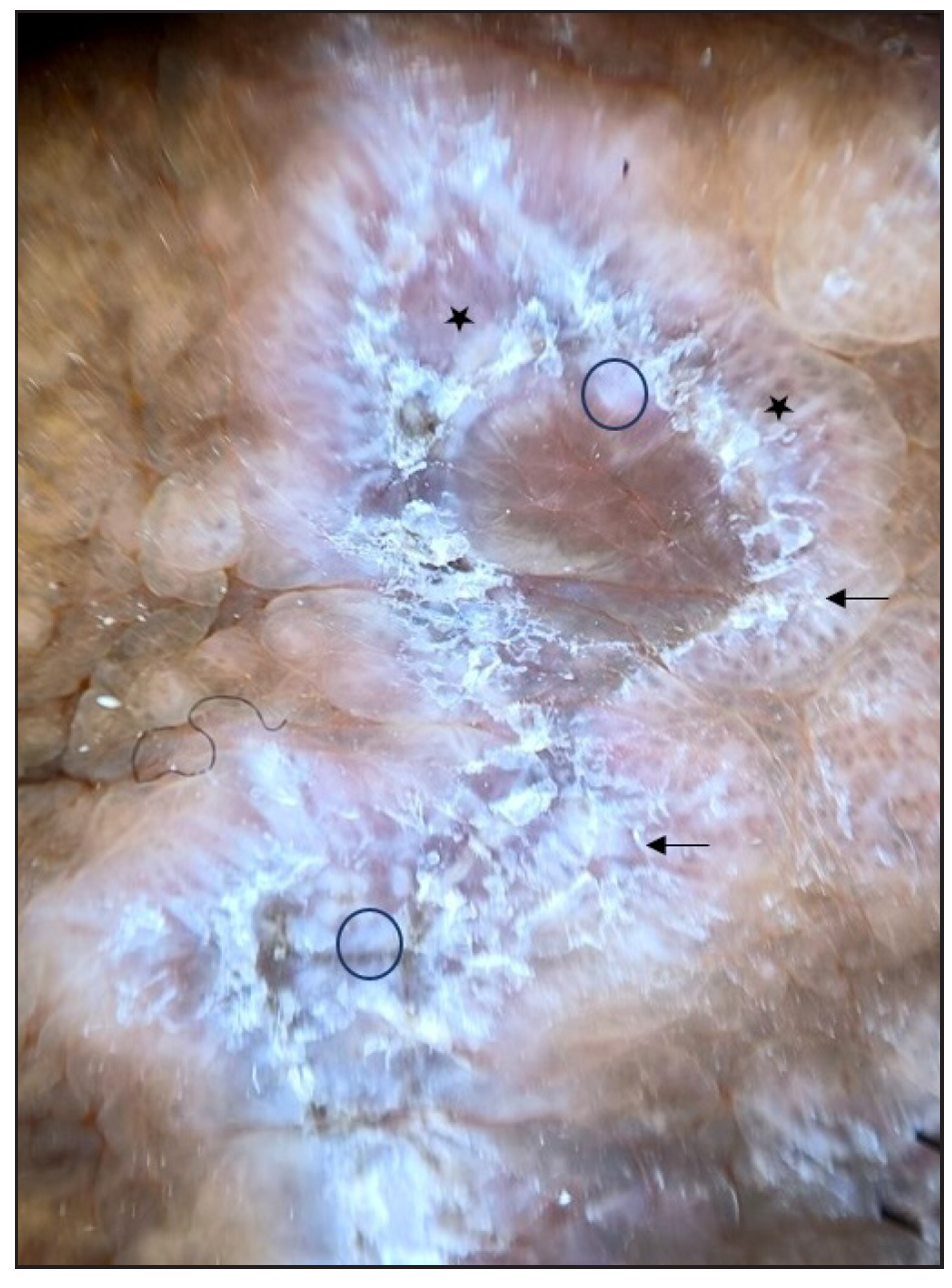 Reticulate Wickham striae (black arrow), structureless white area (black circle), and blue grey globules on the brown background (black stars) (3Gen DermLite DL4 Dermoscope, CA, USA×10 polarised mode).