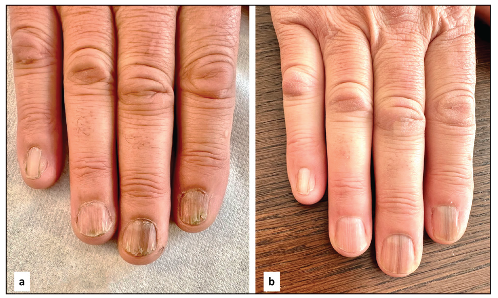 A 65-year-old man before (a) and after (b) 3 months of treatment. NALSI, calculated from the fifth to the second fingernail, is 4-I/8/8/8 at baseline and it is reduced to 0-I/0/4/2 after 3 months. Notably, pterygium and longitudinal melanonychia seem to be resistant to treatment.