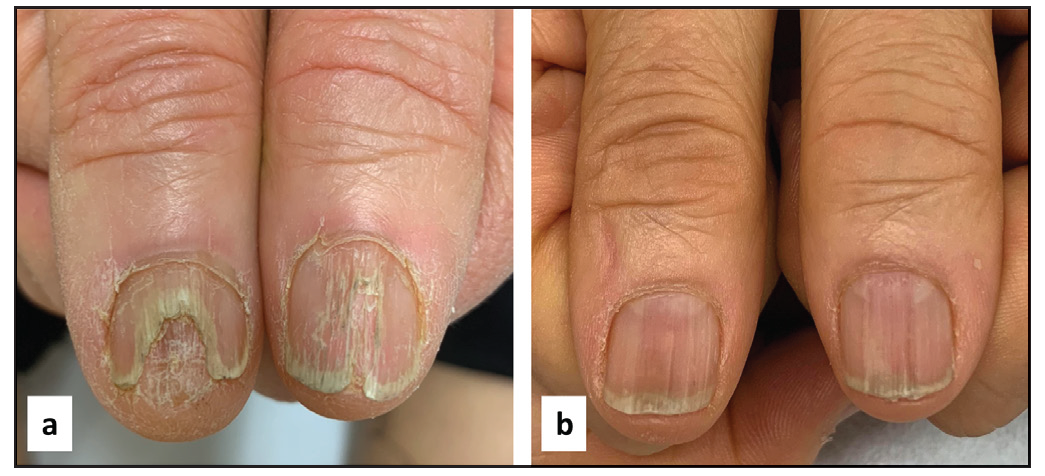 A 51-year-old man before and after 3 months of treatment. NALSI, calculated from the right to the left patient’s nail, is 10/8 at baseline and it is reduced to 4/4 after 3 months.