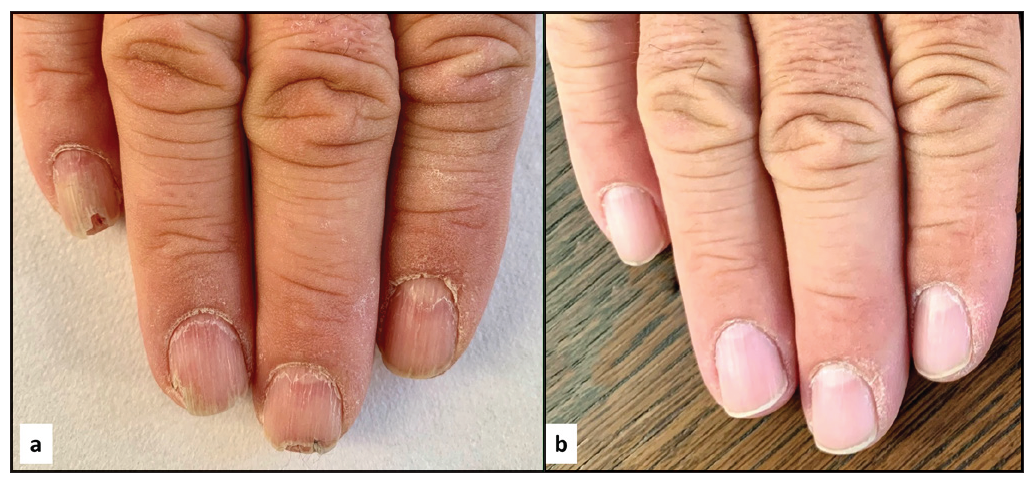 A 59-year-old before and after 3 months of treatment. NALSI, calculated from the fifth to the second fingernail, is 8/6/6/4 at baseline and it is reduced to 0/0/0/0 after 3 months.