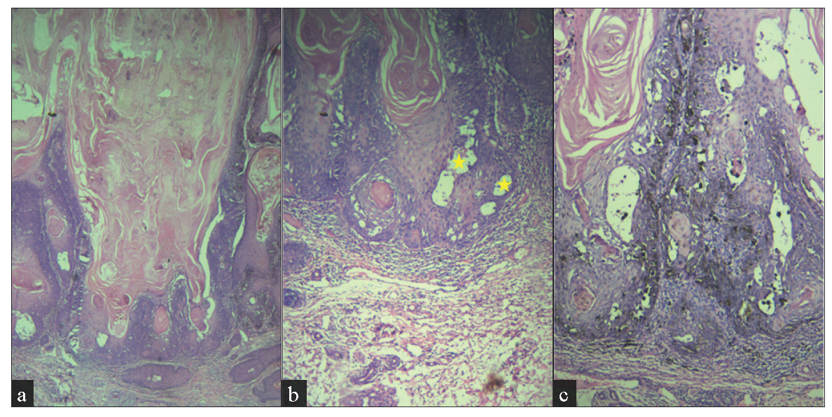 (a) Exo and endophytic proliferative squamous lesion with a central cup-shaped area filled with hyperkeratotic, parakeratinised material with blunt edges at epithelial-stromal interface (Haematoxylin and eosin, 40x), (b) microvesicles (stars) and squamous eddies (400x) and (c) increased dendritic melanocytes (100x).