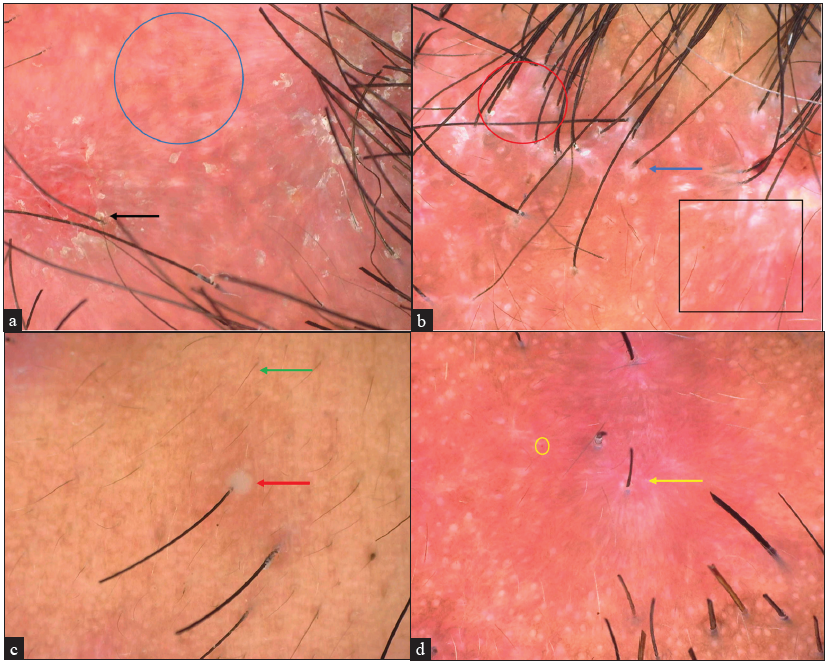 Dermoscopic examination using Dinolite edge (AM7515MZT) with 62x magnification under polarised mode of both cases showing (a) lack of follicular ostia (blue circle), perifollicular scales/crusts (black arrow) (b) perifollicular starburst pattern (blue arrow), white and milky red areas (black square), interfollicular keloid like areas (red circle) and (c) follicular pustules (red arrow), vellus hairs (green arrow), and haemorrhagic crusts (d) perifollicular erythema (yellow arrow), dotted vessels (yellow circle).