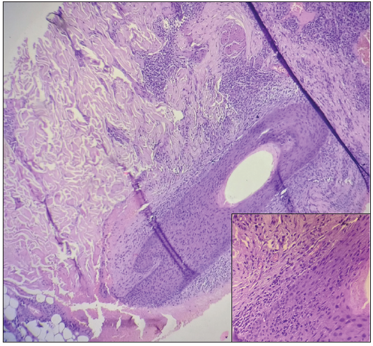 Intrafollicular and perifollicular infiltration of lymphocytes and neutrophils in the first case (Haematoxylin and eosin, 100x, inset 400x).