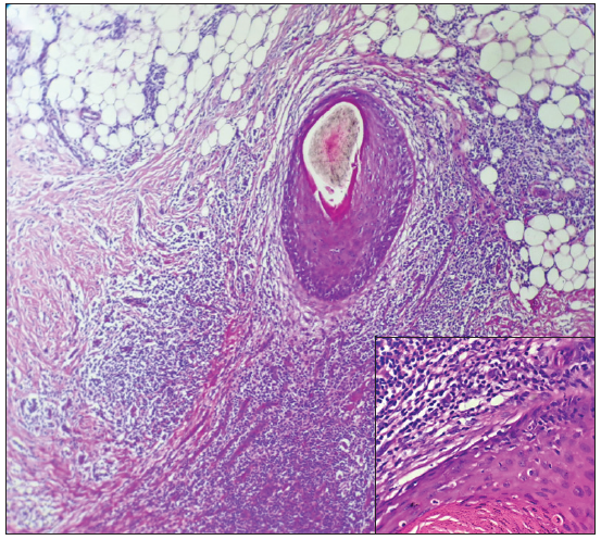 Intrafollicular and perifollicular infiltration of mixed inflammatory infiltrate (predominantly neutrophils and lymphocytes) in the second case (Hematoxylin and eosin, 100x, inset 400x).