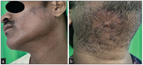 Subsidence of lesions with scarring after six weeks of treatment in both cases.