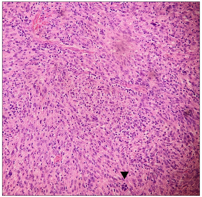 Histopathological image showing highly cellular neoplasia composed of irregularly arranged spindled to epithelioid cells with marked pleomorphism and numerous mitotic figures, including atypical forms (black arrowhead). (Haematoxylin & eosin, 100x).