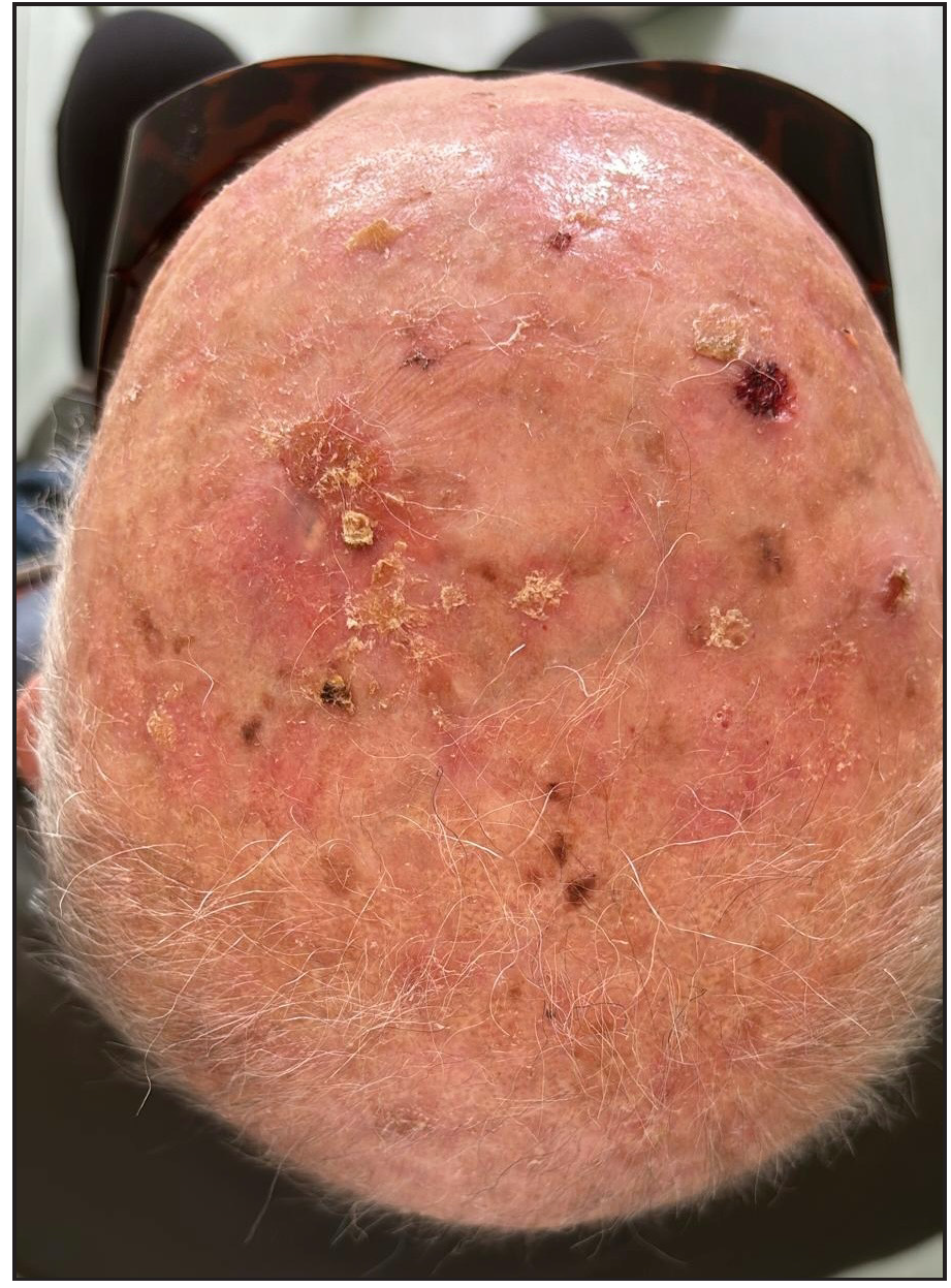 Complete remission of the lesion after a single dose of cemiplimab. Photo taken 6 weeks after cemiplimab infusion.