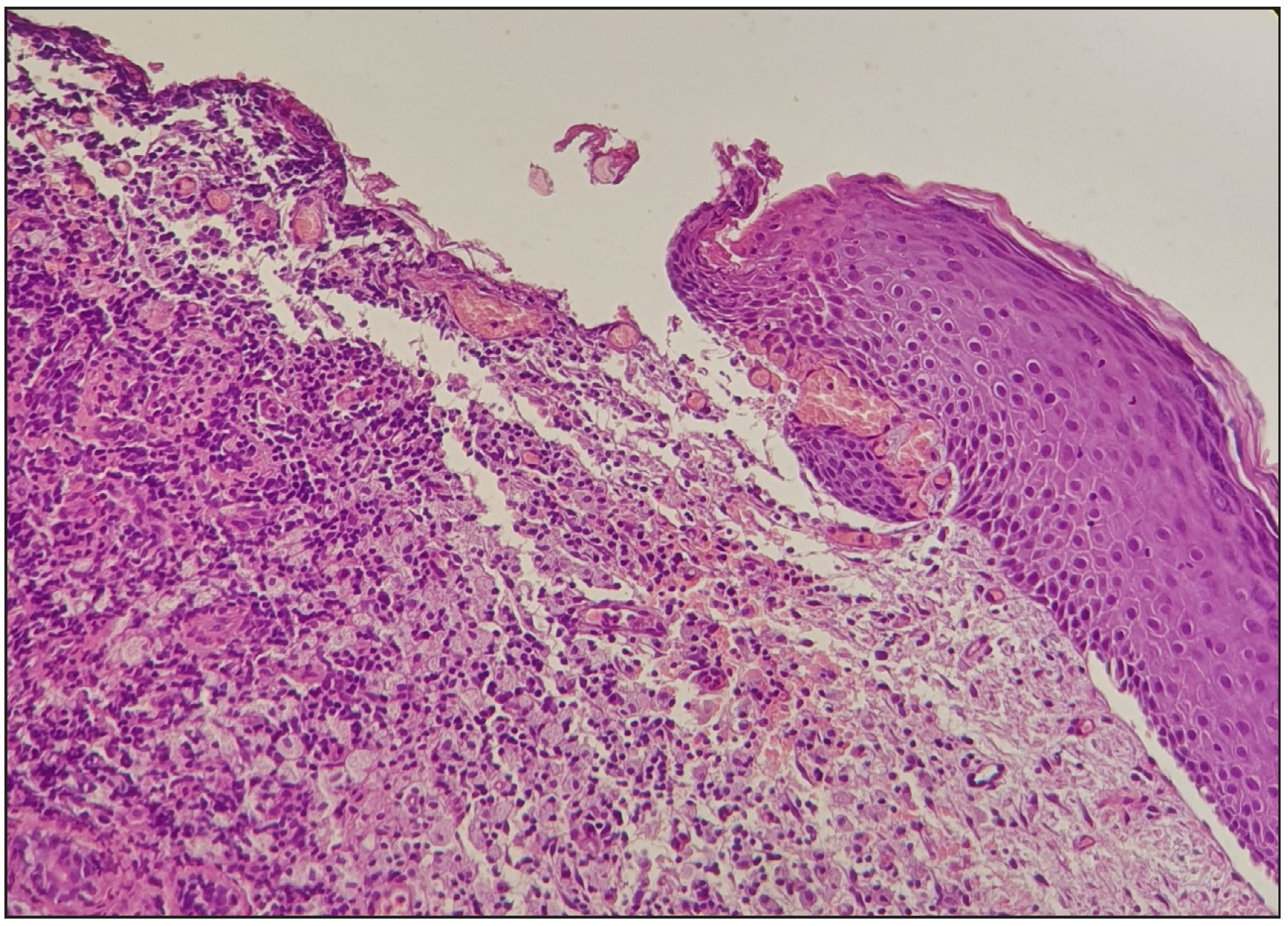 Histopathological image of epidermal erosion and abundant chronic inflammation predominantly composed of lymphocytes and histiocytes with mild fibrosis in the dermis. (Haematoxylin & eosin, 100x).