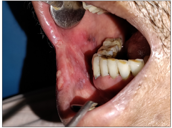 (Moderate category) oral ulcers on the right buccal mucosa.