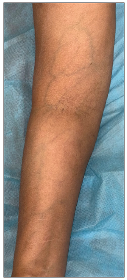 The volar tributaries of the vein in the right upper limb before drug challenge in patient 1.