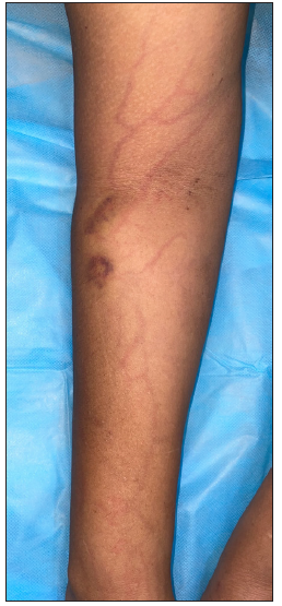 Erythema along the volar tributaries of the cannulated vein in the right upper limb after drug challenge in patient 1.