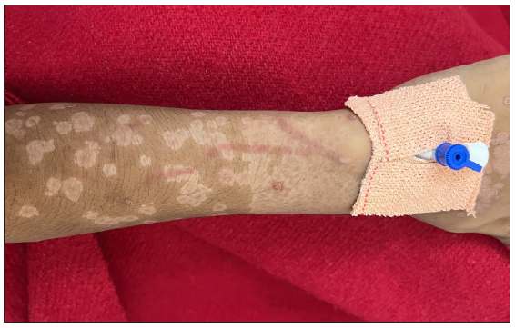 Erythema along the tributaries of the cannulated vein in patient 2.