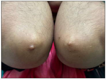 Skin-coloured nodule over bilateral elbow joints.