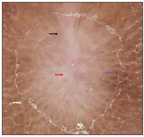 Dermoscopy showing yellow-white area in the centre (red arrow), blurred vessels (black arrow), whitish-brown area in the background (blue arrow) and peripheral white scale [DermLite DL4, 10x magnification, polarised mode].