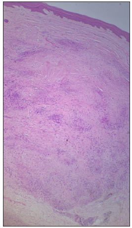 Well-circumscribed inflammatory infiltrate in the deep dermis and upper subcutaneous tissue [Haematoxylin & eosin, 40x].