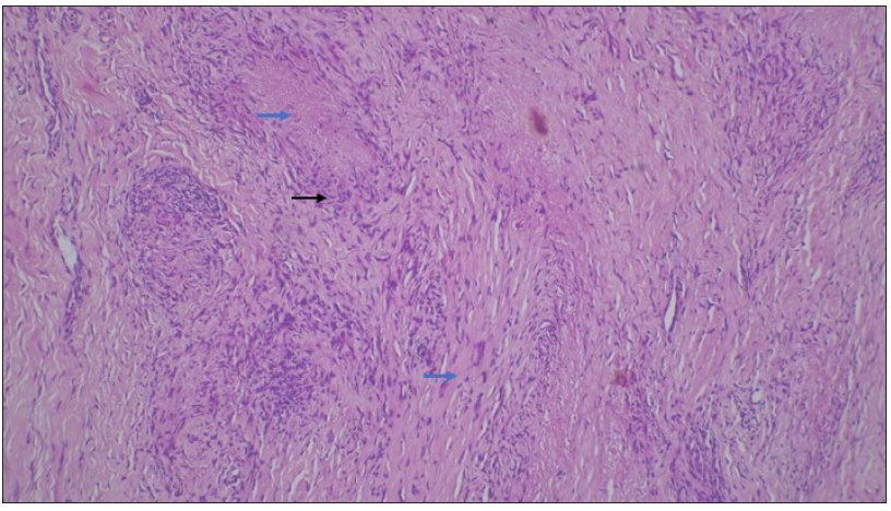 Areas of altered collagen in the centre (eosinophilic material) (blue arrows) surrounded by palisading of the inflammatory cell (black arrow) [Haematoxylin & eosin, 100x].