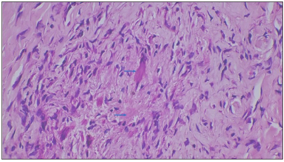 Fibrinous degeneration of collagen (blue arrows) surrounded by palisading of histiocytes [Haematoxylin & eosin, 400x].