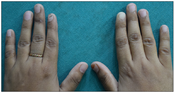 Post-treatment images of the dorsum of both hands.