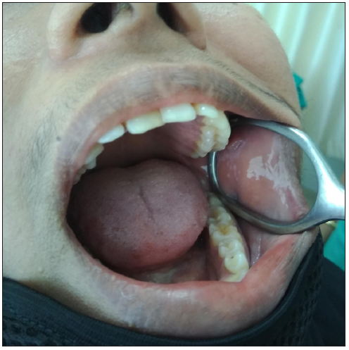 Examination of the oral cavity using the instrument. The skin clamp provides a large window for visualising mucosa (which is not possible with a tongue depressor) and also provides a good view to perform a biopsy. Gentle pressure from outside could help further in stabilising the tissues.