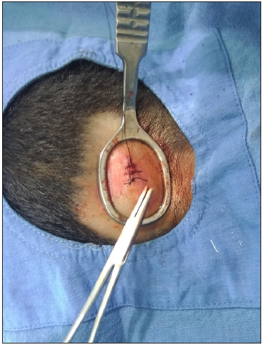 Annular haemostasis for skin suturing or other procedures especially on highly vascular areas like the scalp.