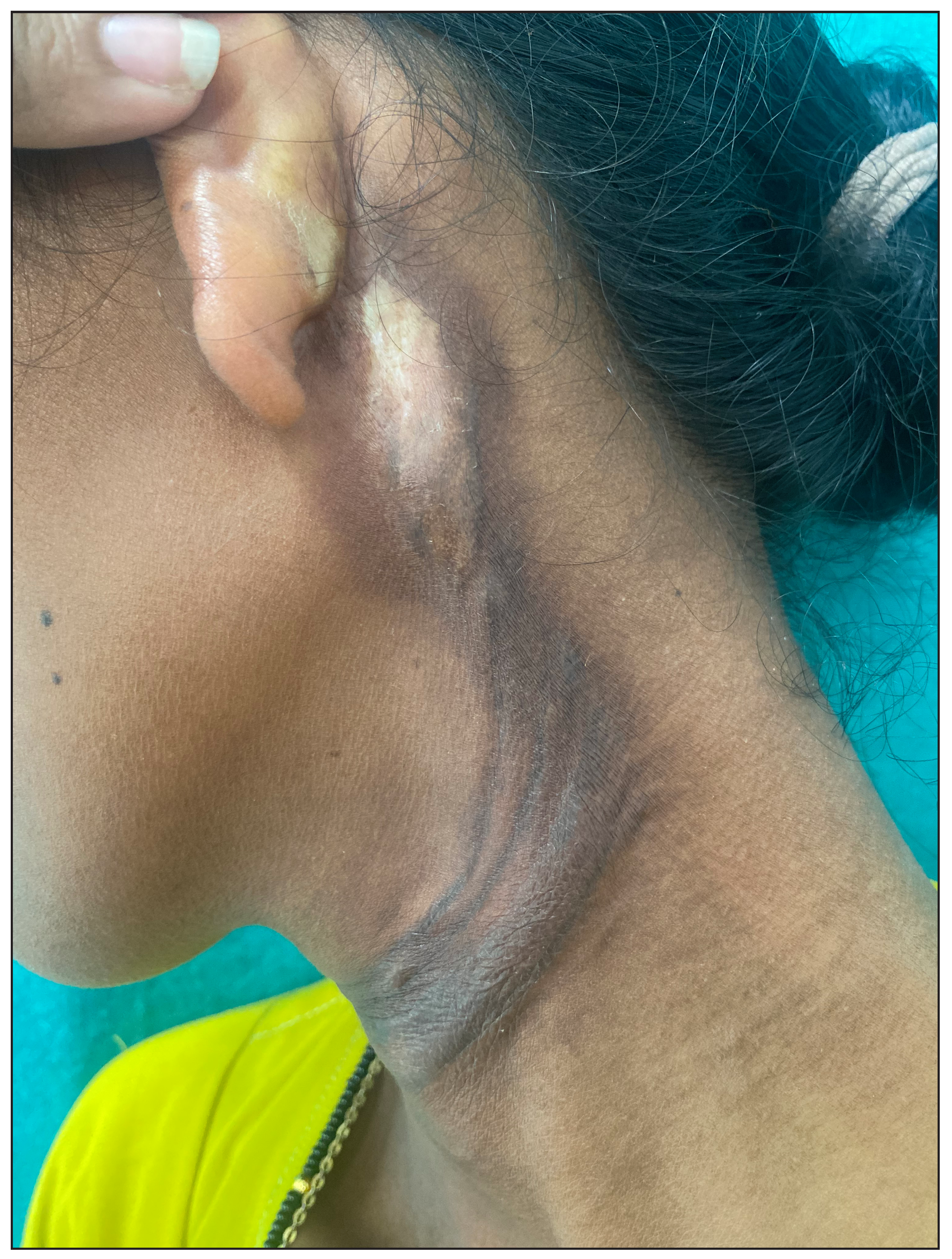 Ill- to well-defined, firm to hard, greyish-brown, indurated plaque present over the neck extending from behind the left ear to the anterior aspect of the neck.