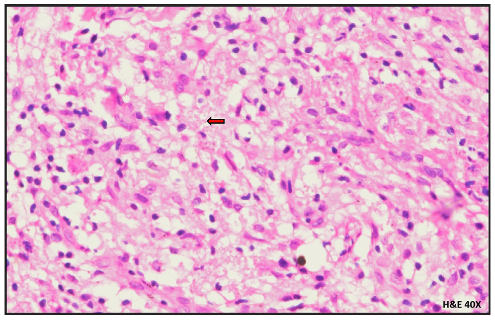 Foamy histiocytes with 1-2 µm-sized organisms with clear space around (red arrow) (Haematoxylin & eosin, 40x),