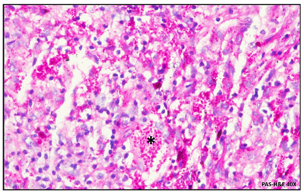Eosinophilic budding yeast cells (black asterix) (PAS-40x).