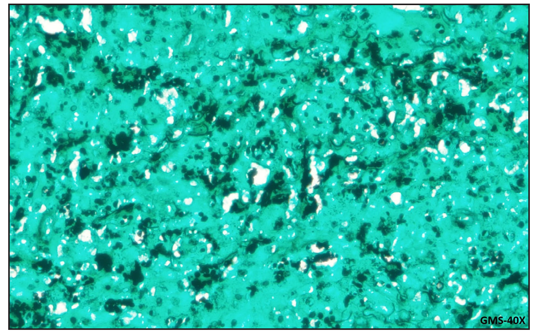 Black budding yeast cells (Gomory methenamine silver (GMS)-40x).