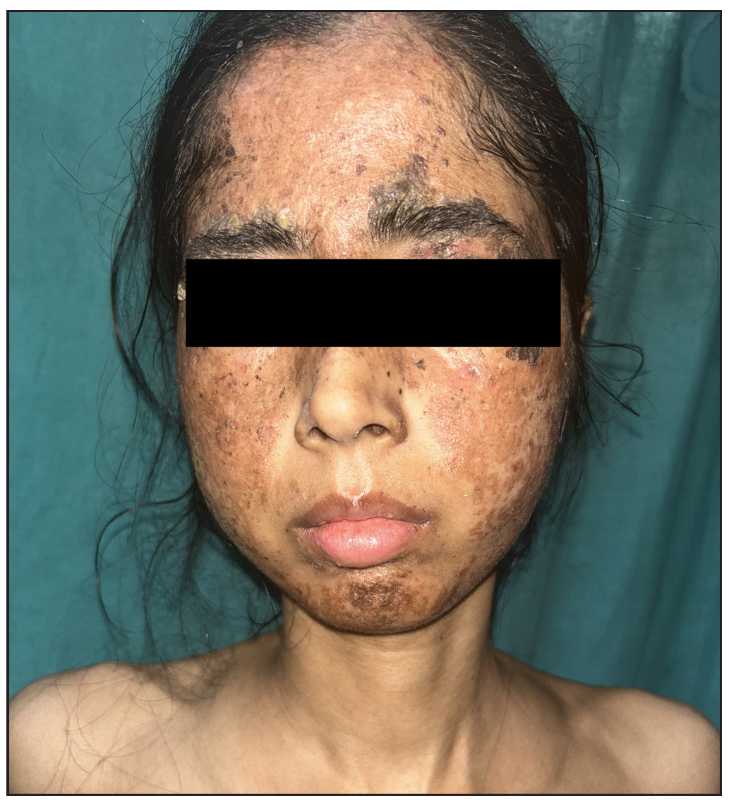 After treatment- Almost complete clearance of skin lesions with residual crust and hyperpigmentation.