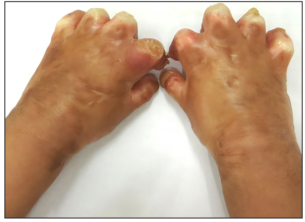 Digital shortening with flexion contractures and joint deformities