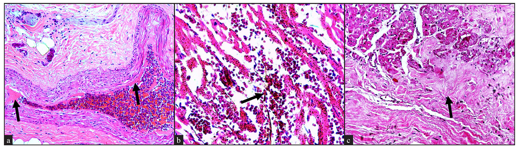 Histopathological examination of cardiac tissue on haematoxylin and eosin stained sections showed (a) Organised coronary thrombus (black arrows); (Haematoxylin & eosin staining, 100×), b) Foci of myocardial haemorrhage (black arrow; Haematoxylin & eosin staining, 200×) and c) Extensive myocardial fibrosis (black arrow; Haematoxyin & eosin staining, 200×).