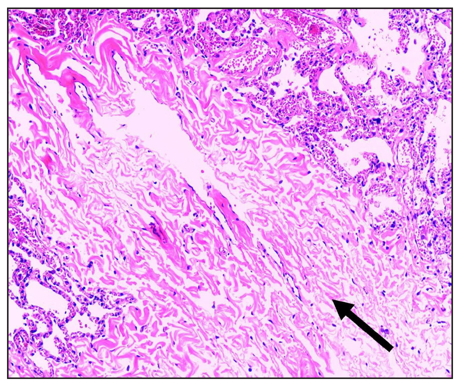 Focal pulmonary fibrosis (black arrow; Haematoxylin & eosin staining, 100×).