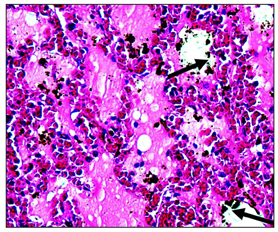 Pulmonary oedema and congestion with characteristic heart failure cells: black arrow (Haematoxylin & eosin staining, 200×).