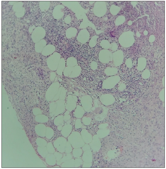 Section shows septolobular panniculitis without evidence of vasculitis, consistent with EN. (Haematoxylin & eosin, 10x).