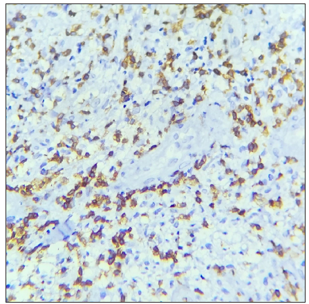 The section shows marked presence of CD3+ T cells. (IHC with DAB staining: 40x, Chronic EN)