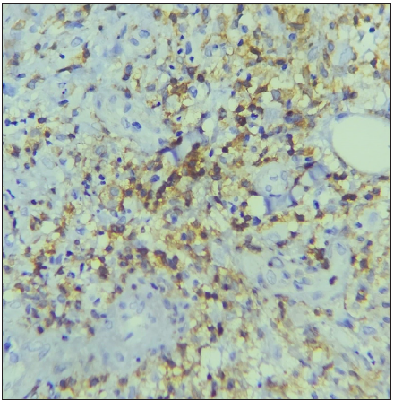 The section shows an increased density of CD4+ T cells. (IHC with DAB staining: 40x, Chronic EN)