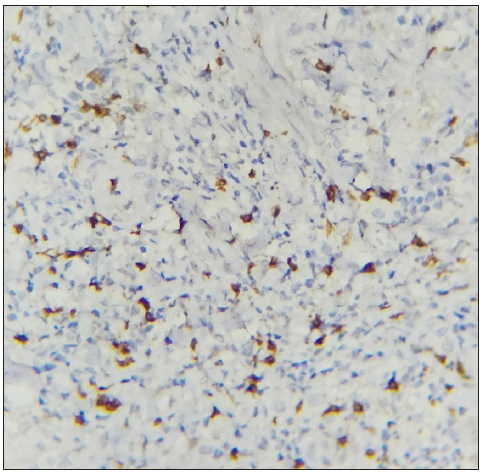 The section shows notable presence of CD8+ T cells. (IHC with DAB staining: 40x, Chronic EN)