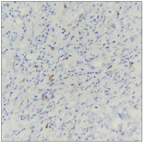 The section shows scattered CD56+ NK cells. (IHC with DAB staining: 40x, Chronic EN)