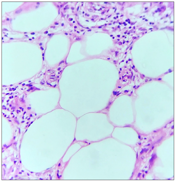 Section shows dense lymphocytic septolobular panniculitis, consistent with EN. (Haematoxylin & eosin, 40x).