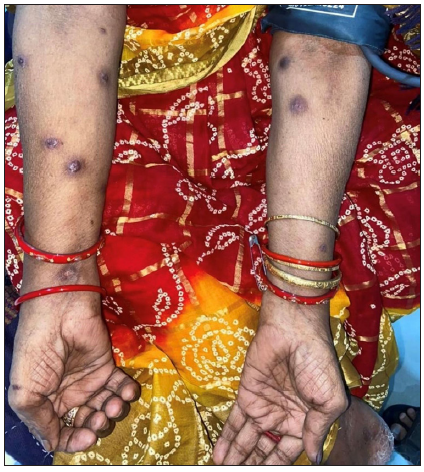 Chronic EN with multiple subcutaneous nodules on the flexural aspects of the forearms in a case of rheumatoid arthritis, with characteristic hand deformities.