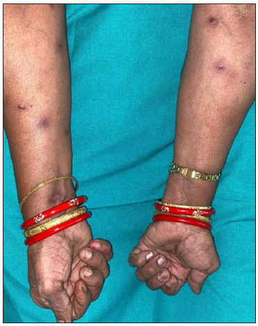 Follow-up image showing only partial resolution of lesions despite 3 months of treatment.