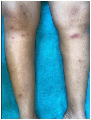 Classic EN with erythematous, tender subcutaneous nodules on bilateral shins.