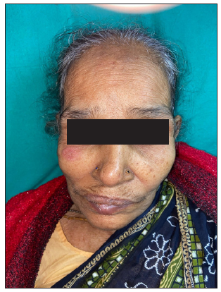 Atypical EN with erythematous subcutaneous nodule on the face.