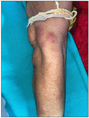 Atypical EN with erythematous subcutaneous nodule on the right upper limb.