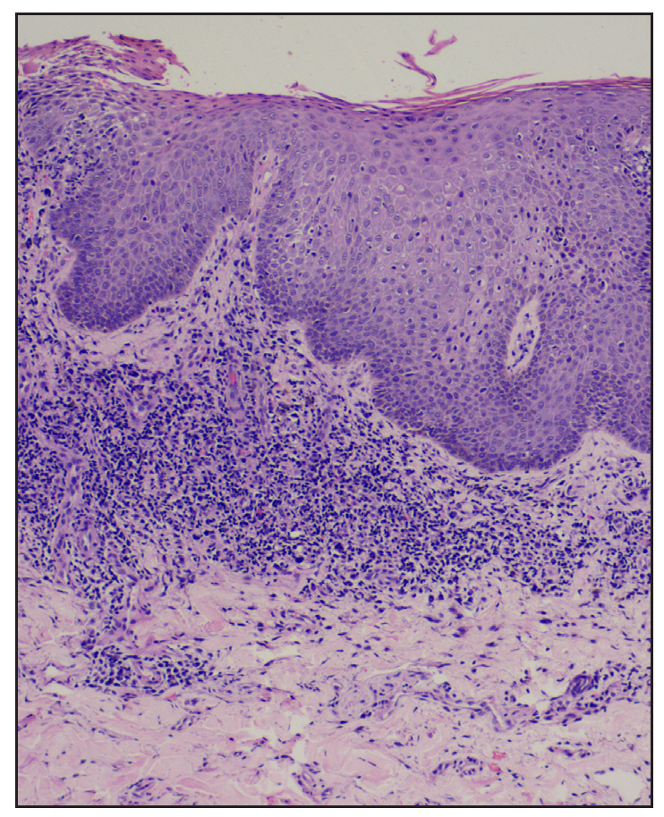 Histopathology shows an acanthotic epidermis with focal parakeratosis, mild spongiosis, exocytosis, basal cell vacuolisation, and a dense band of lichenoid infiltrate consistent with the lichenoid eruption (Haematoxylin & eosin, 400x).