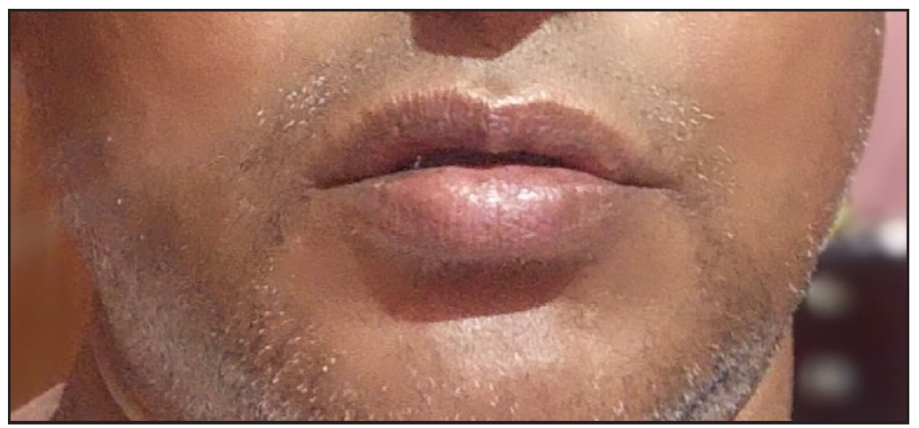 Complete subsidence of lesions post therapy.