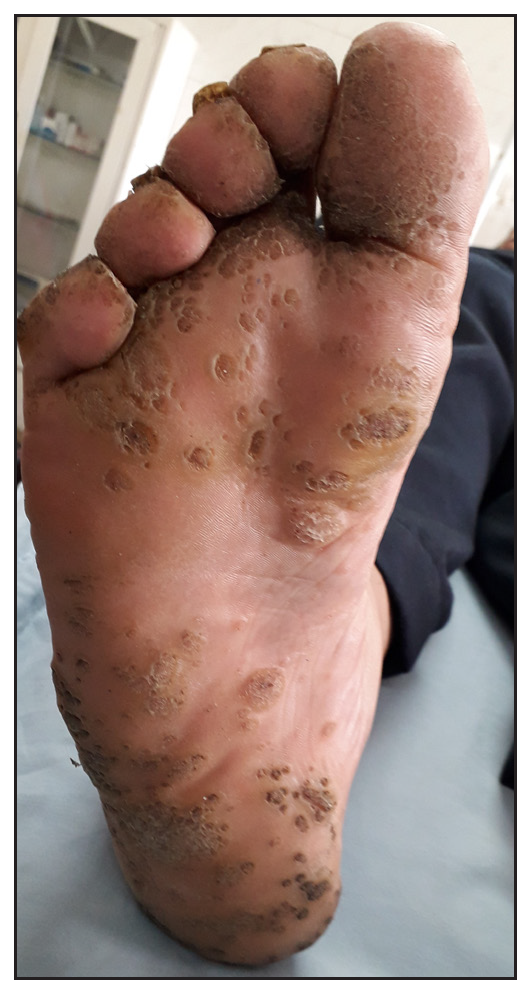 Male patient aged 25 y in the MMR group with multiple plantar warts, (before treatment).