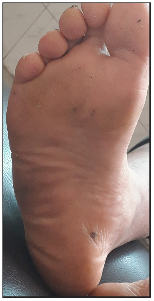 After five sessions of IL MMR with excellent response, (polarised, 20x).